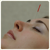 Woman receiving acupuncture.